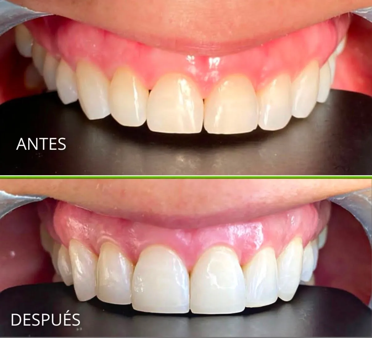 Carillas de un diseño de sonrisa en los dientes superiores, antes y después