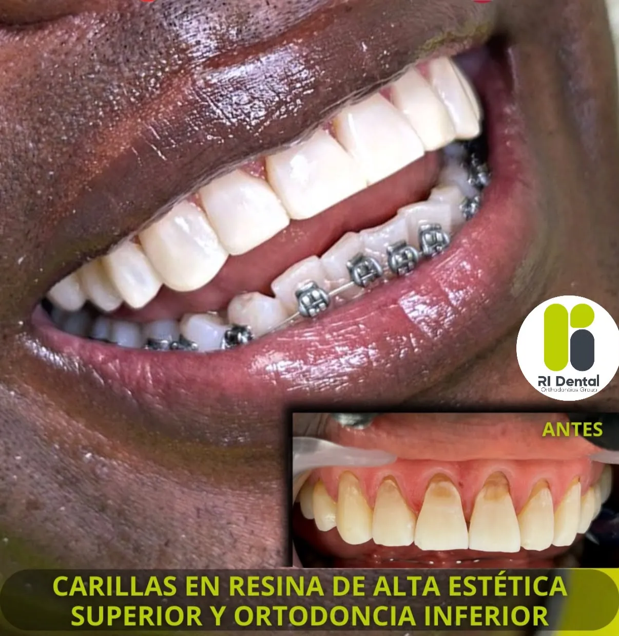 Antes y después de carillas superiores en resina con ortodoncia inferior