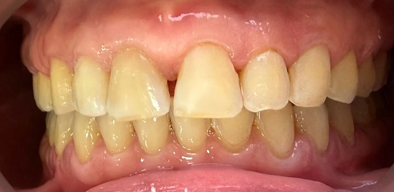 Antes: caso 1 · porcelana e.max