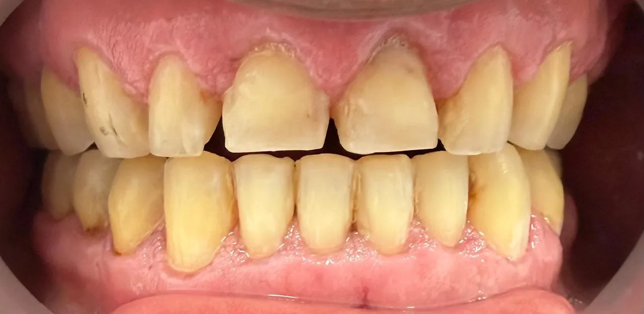Antes: caso 2 · porcelana e.max