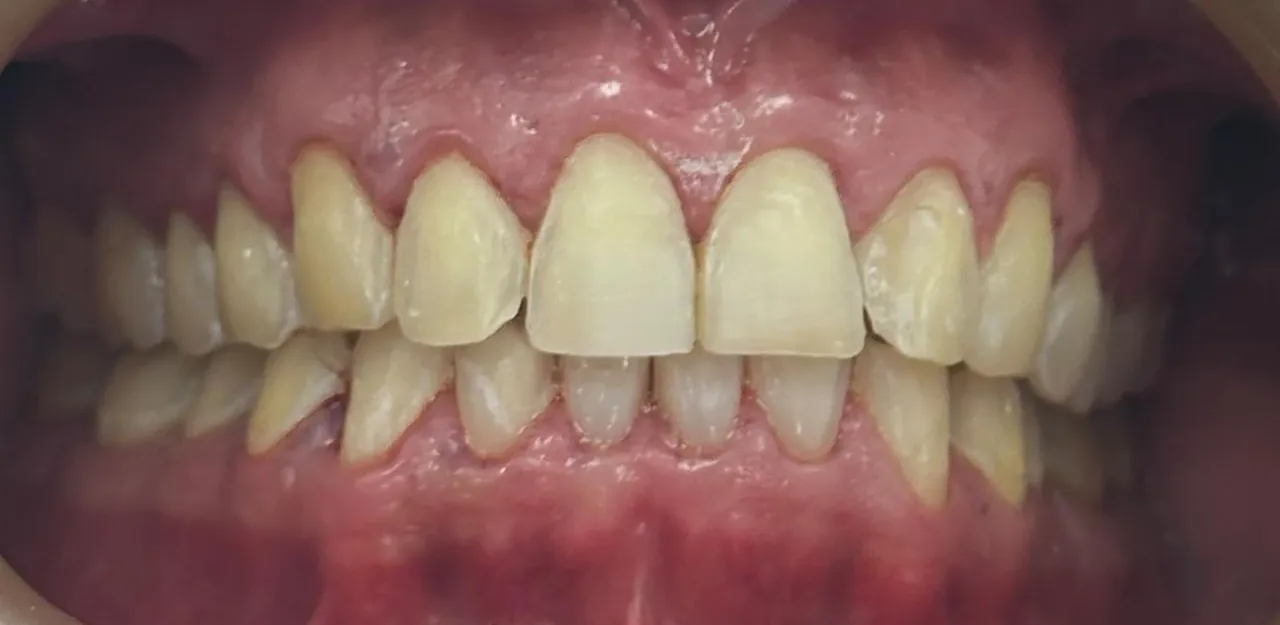 Antes: caso 3 · porcelana e.max