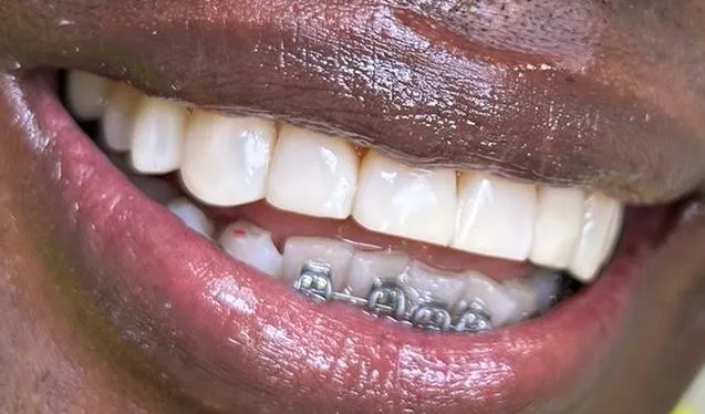 Valor diseño de sonrisa en resina: carillas superiores de resina de alta estética en Medellín