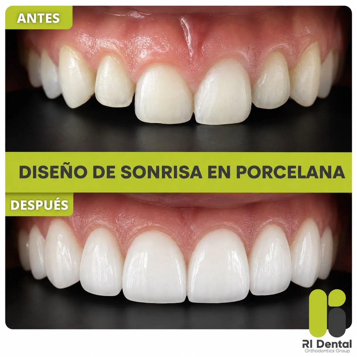 Antes y después de un diseño de sonrisa con carillas de porcelana