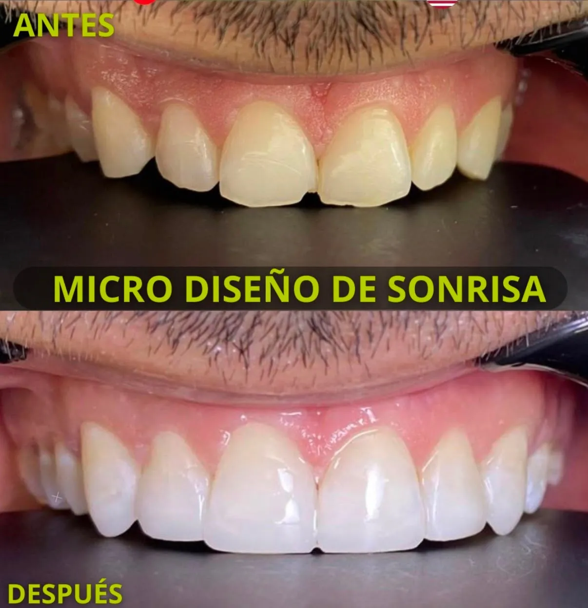 Antes y después de un microdiseño de sonrisa en dientes superiores