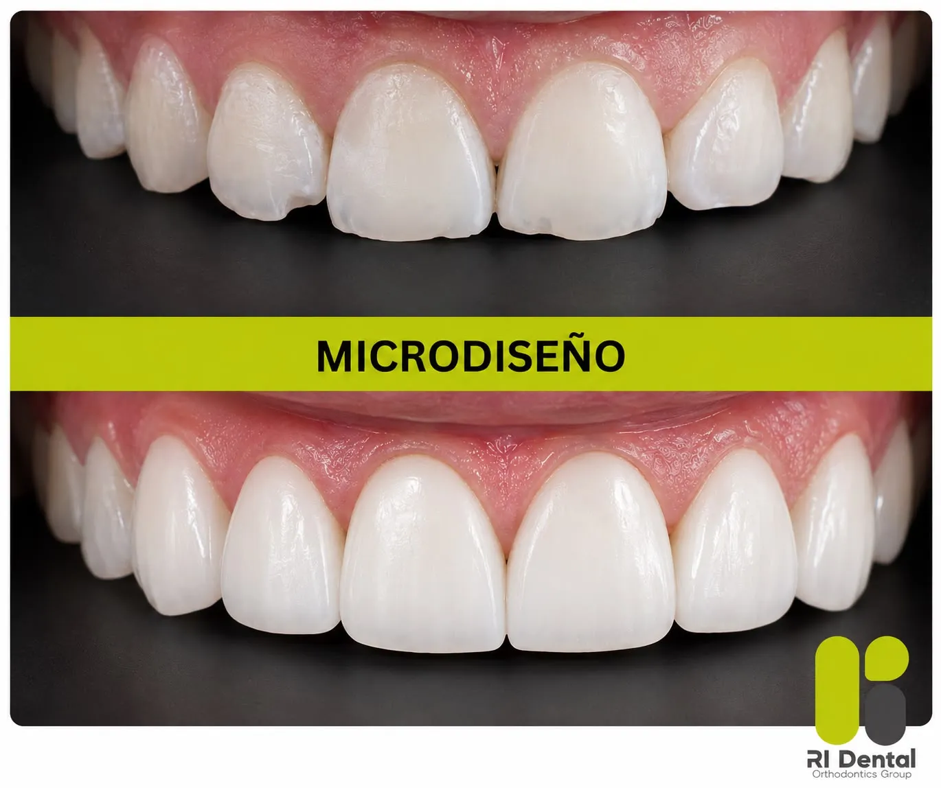 Antes y después de un mini diseño de sonrisa que corrige bordes fracturados