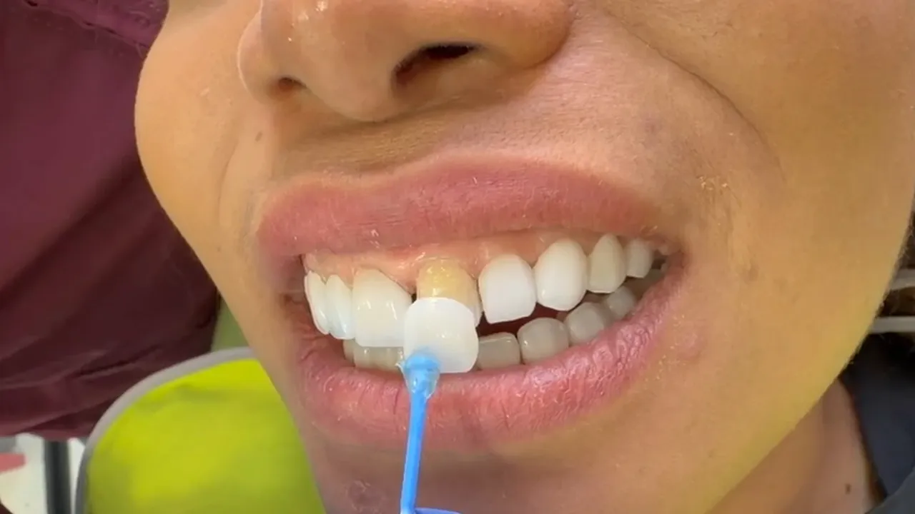 Prueba de una carilla en un incisivo central durante un diseño de sonrisa